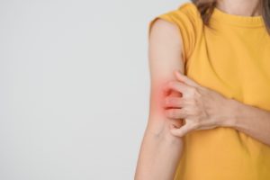 Woman,Itching,And,Scratching,Itchy,Arm.,Sensitive,Skin,Allergic,Reaction